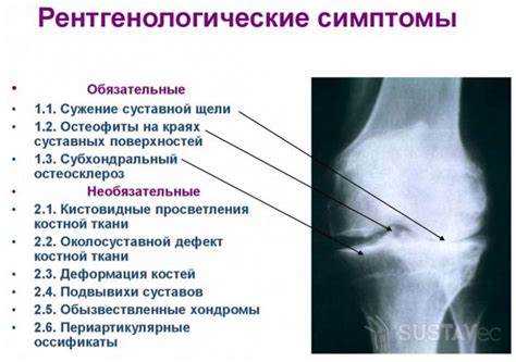 Что такое субхондральный склероз крыши вертлужных впадин?