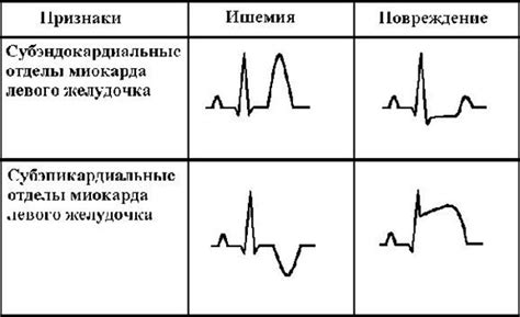 Что такое субэпикардиальная ишемия миокарда на ЭКГ?