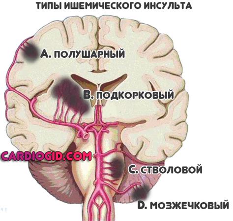 Что такое хроническая ишемия мозга 2 степени?