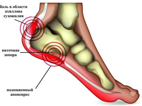 Что такое шпора на пятке?