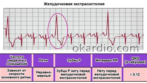 Что такое экстрасистолия желудочковая?