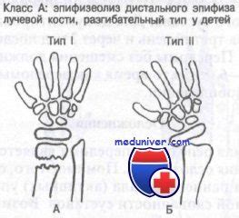 Что такое эпифизеолиз лучевой кости без смещения?