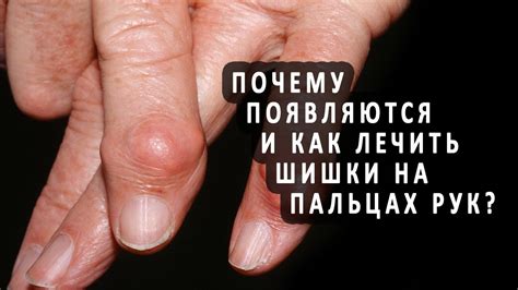 Шишки на пальцах: мифы и реальность