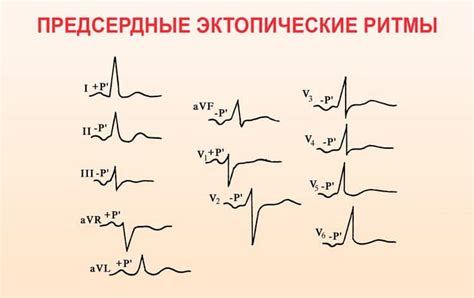 Эктопический предсердный ритм у подростка