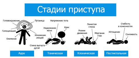 Эпилептические приступы