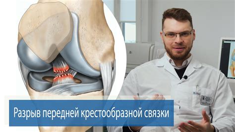 Эффективные методы лечения порванной передней крестообразной связки колена