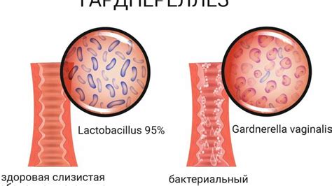 Эффективные методы профилактики гарднереллы