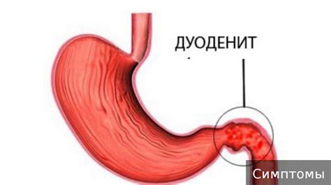 Язва двенадцатиперстной кишки: какие признаки нужно учесть?