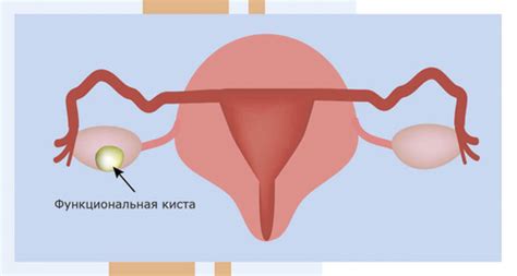 Яичниковая киста: симптомы и способы лечения