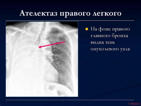  Ателектаз средней доли правого легкого: причины и симптомы 