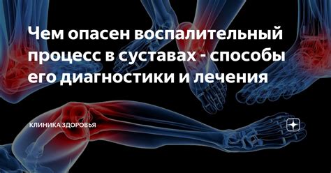  Воспалительный процесс в суставах после лучевой терапии 