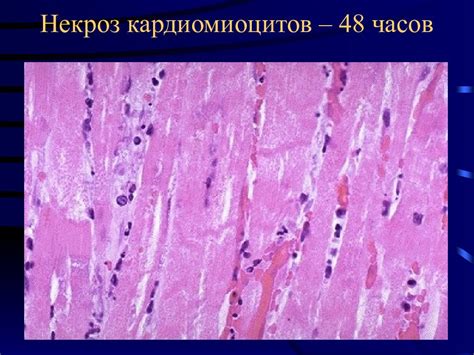  Ишемическая некроз 