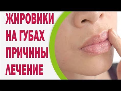  Как избавиться от белых точек под кожей губ 