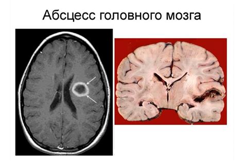  Причины обызвествления фалькса головного мозга 