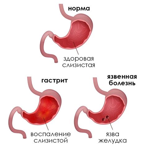 4. Гастрит и язва желудка